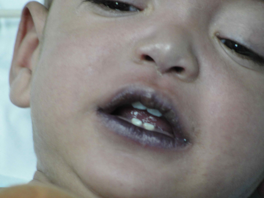 children common illnesses blue-babies
