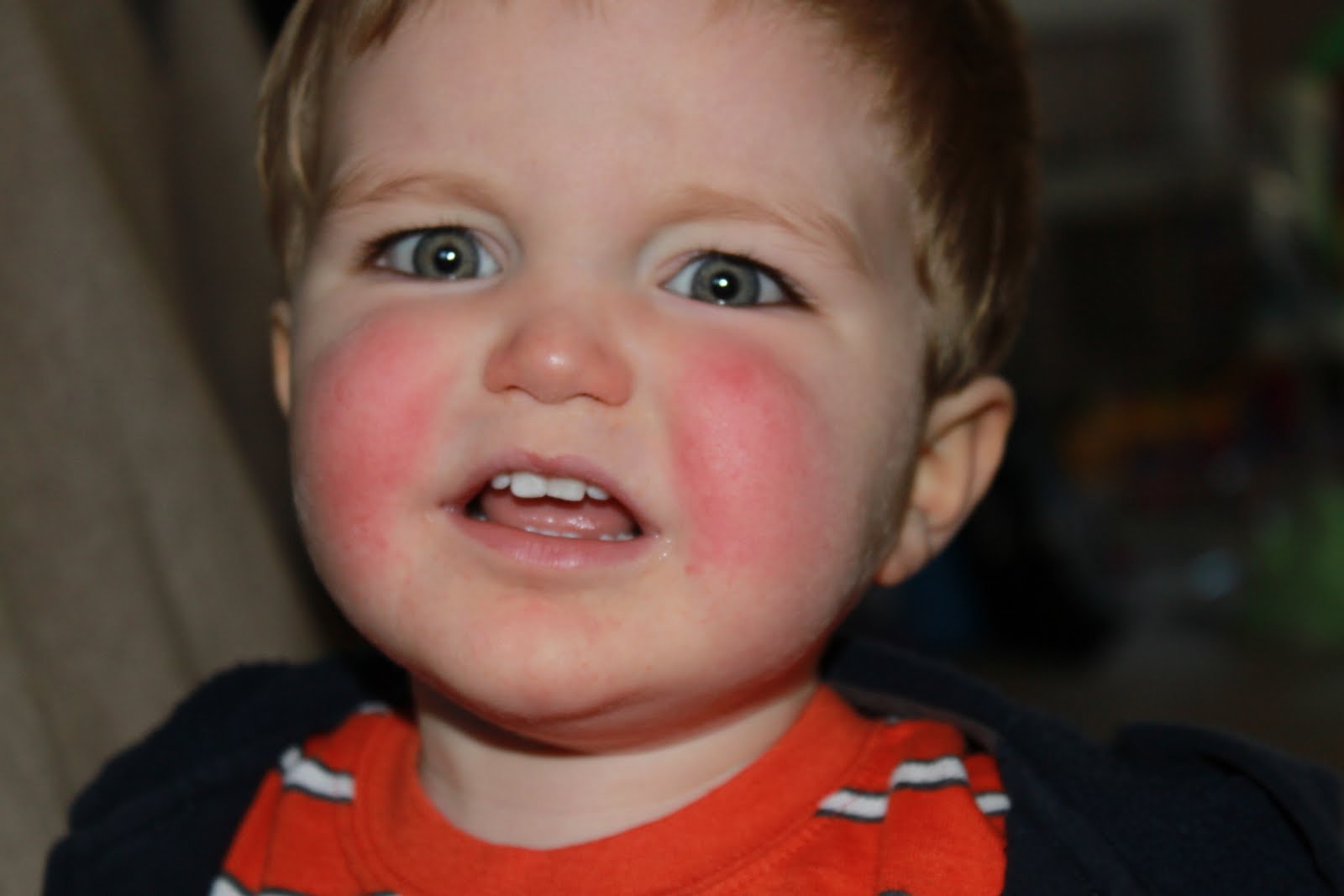 children common illnesses slapped cheek